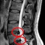MRI confirmed disc herniation causing sciatica